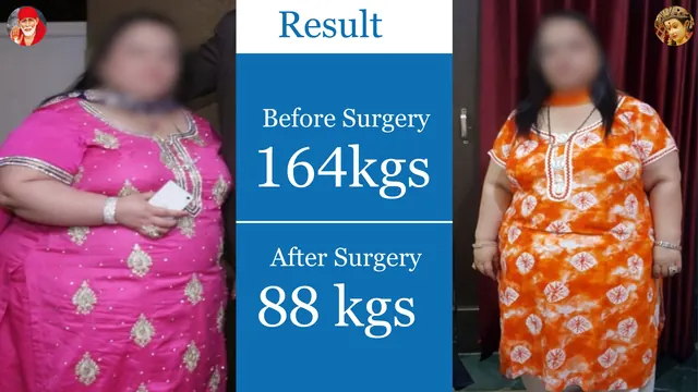 Patient result, face blurred for privacy: 164 kg → 88 kg, After bariatric surgery