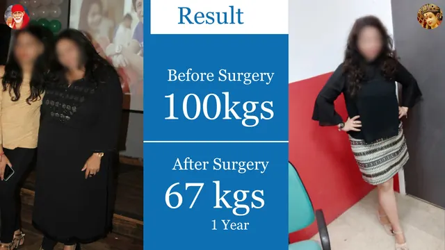Patient result, face blurred for privacy: 100 kg → 67 kg, 1 year after surgery