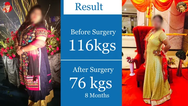 Patient result, face blurred for privacy: 116 kg → 76 kg, 8 months after surgery