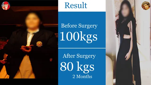 Patient result, face blurred for privacy: 100 kg → 80 kg, 2 months after surgery
