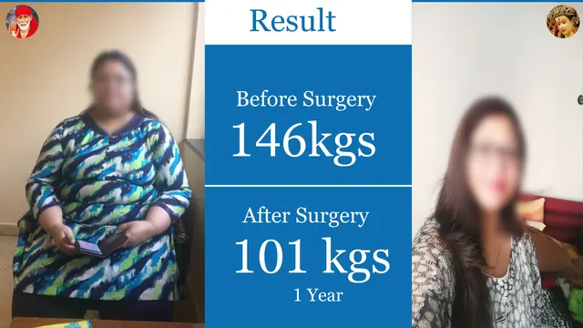 Patient result, face blurred for privacy: 146 kg → 101 kg, 1 year after surgery
