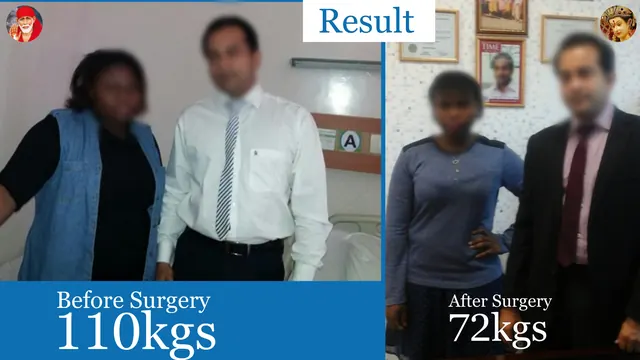Patient result, face blurred for privacy: 110 kg → 72 kg, After bariatric surgery