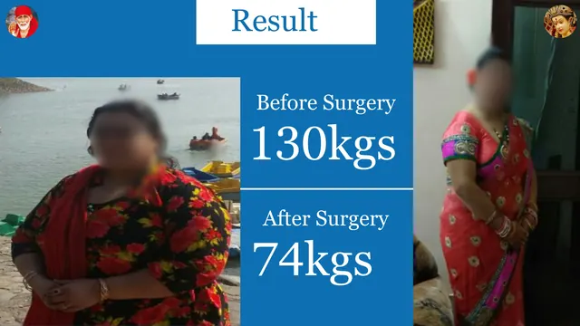 Patient result, face blurred for privacy: 130 kg → 74 kg, After bariatric surgery