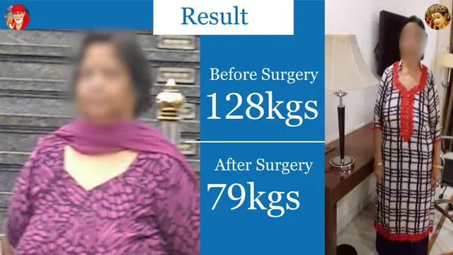 Patient result, face blurred for privacy: 128 kg → 79 kg, After bariatric surgery