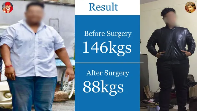 Patient result, face blurred for privacy: 146 kg → 88 kg, After bariatric surgery